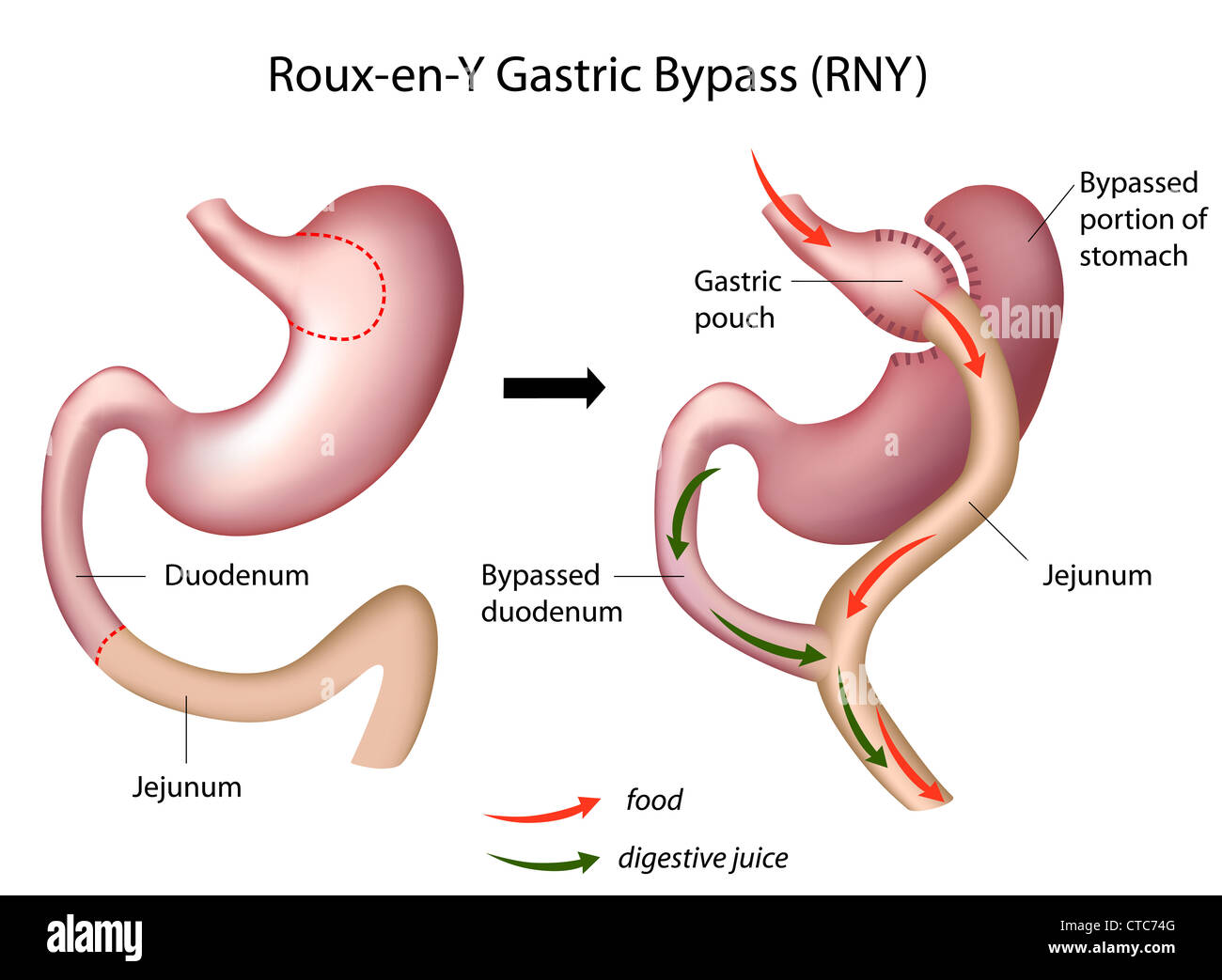 Roux-En-Y Gastric Bypass (Erbettelte) Chirurgie Stockfoto