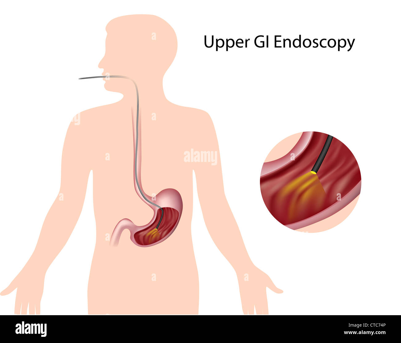 Obere gastrointestinale Endoskopie Stockfoto