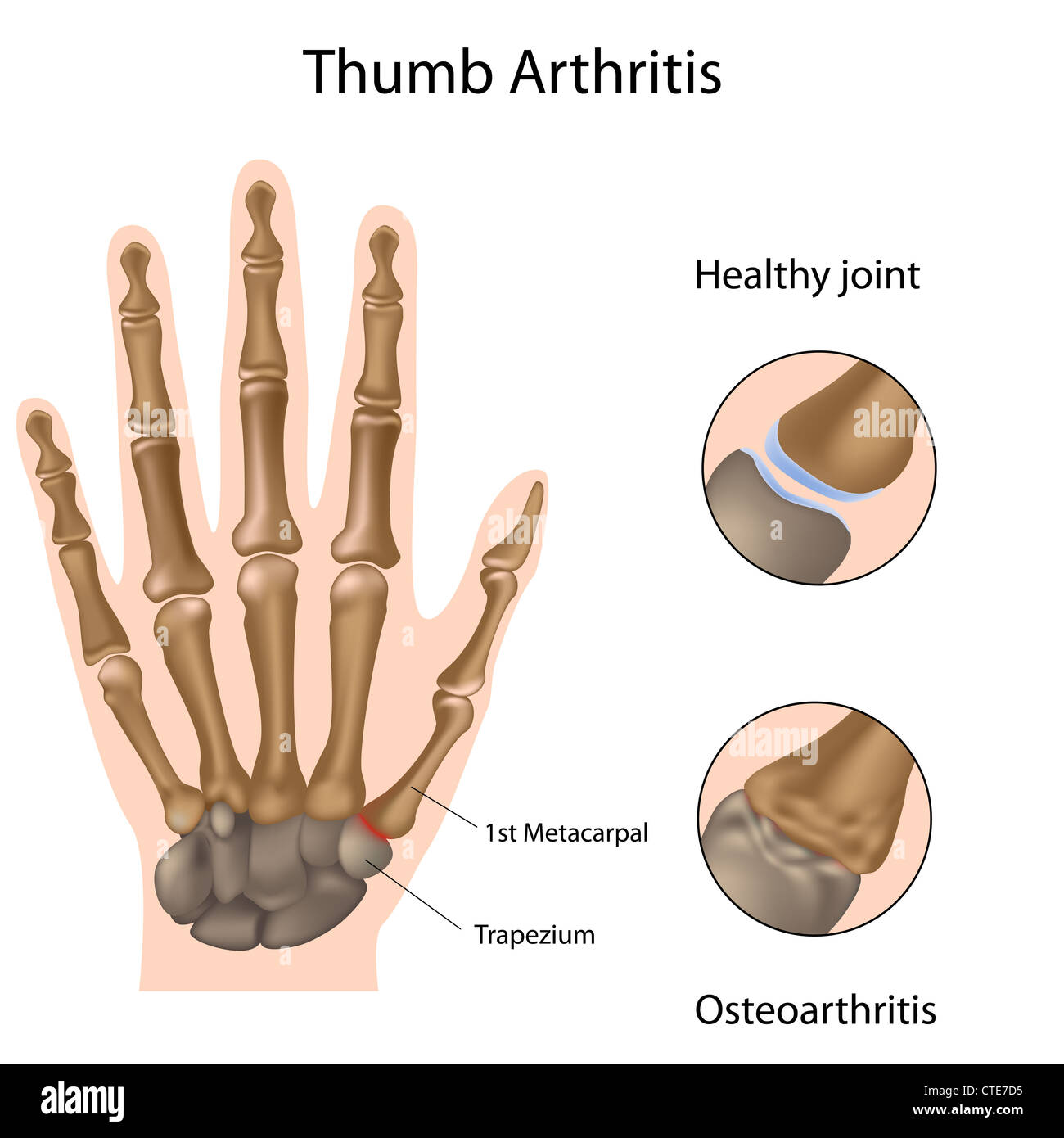 Basis der Daumen arthritis Stockfoto