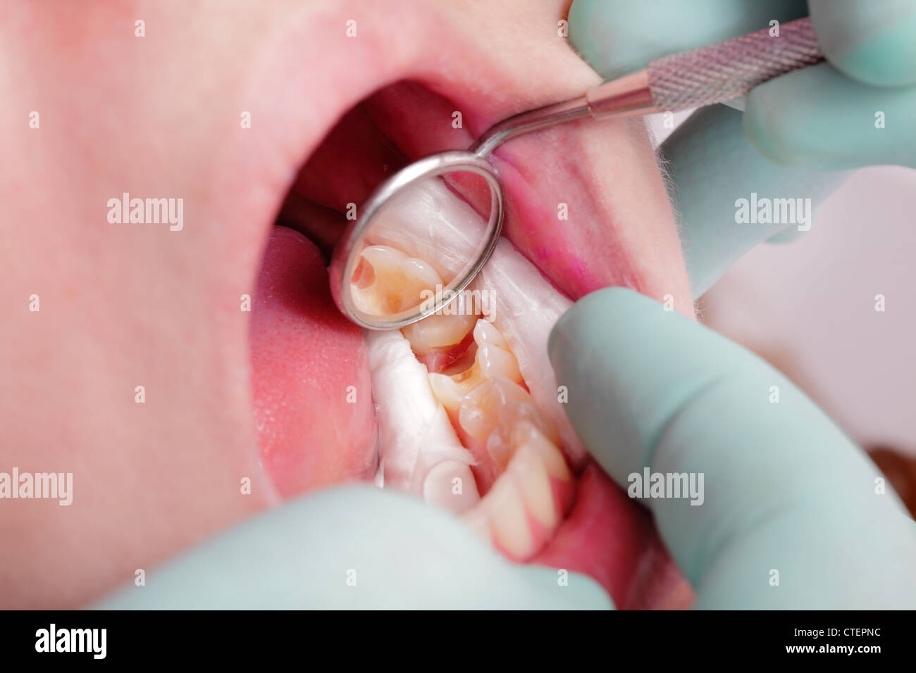 Nahaufnahme von Loch im Zahn nach dem Bohren mit dental Rollen und Spiegel  Stockfotografie - Alamy
