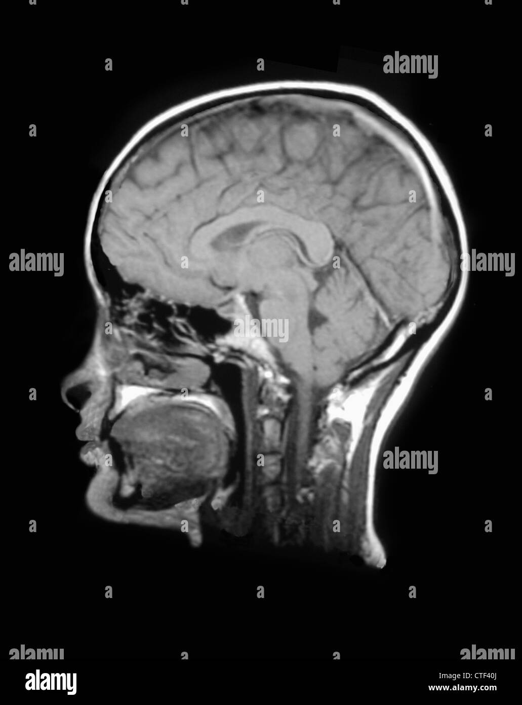 MRT-Untersuchung des menschlichen Kopfes Stockfoto