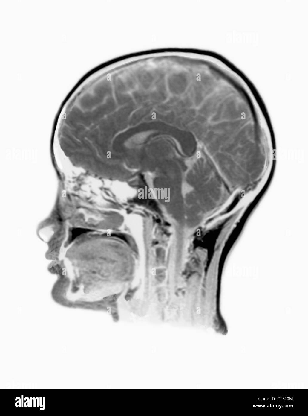 MRT-Untersuchung des menschlichen Kopfes Stockfoto