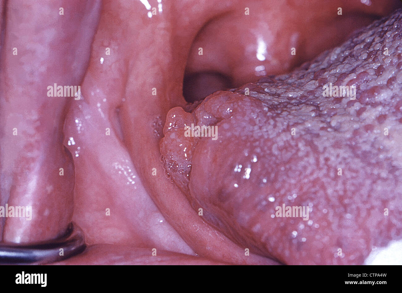 Histoplasmose Infektion der Zunge Stockfoto