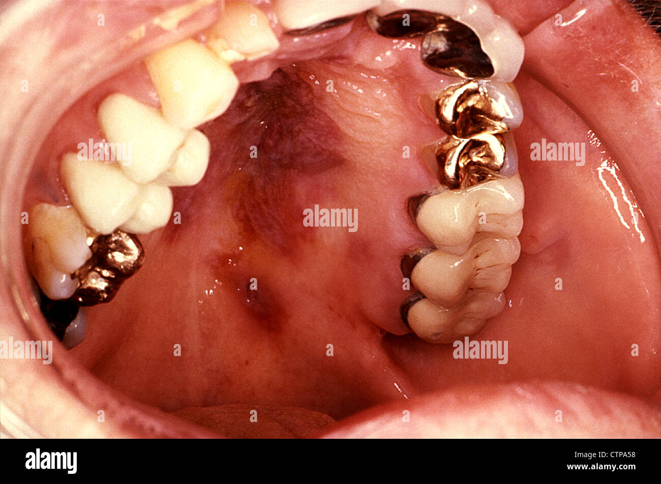 Kaposi-Sarkom Läsion des weichen Gaumens Stockfoto