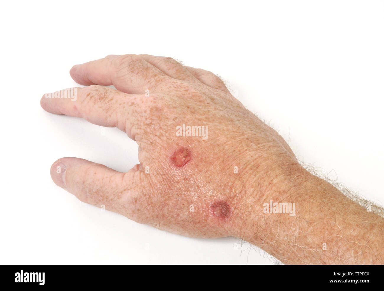Kryotherapie Behandlung präkanzeröse Zellen aus einer Hand zu entfernen Stockfoto
