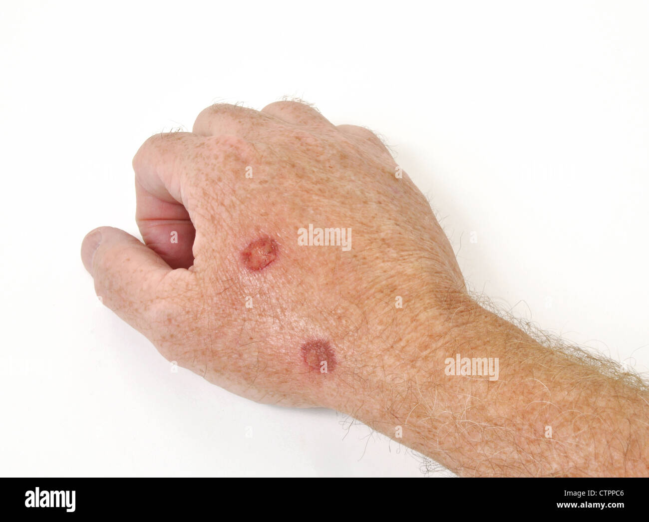 Kryotherapie Behandlung präkanzeröse Zellen aus einer Hand zu entfernen Stockfoto