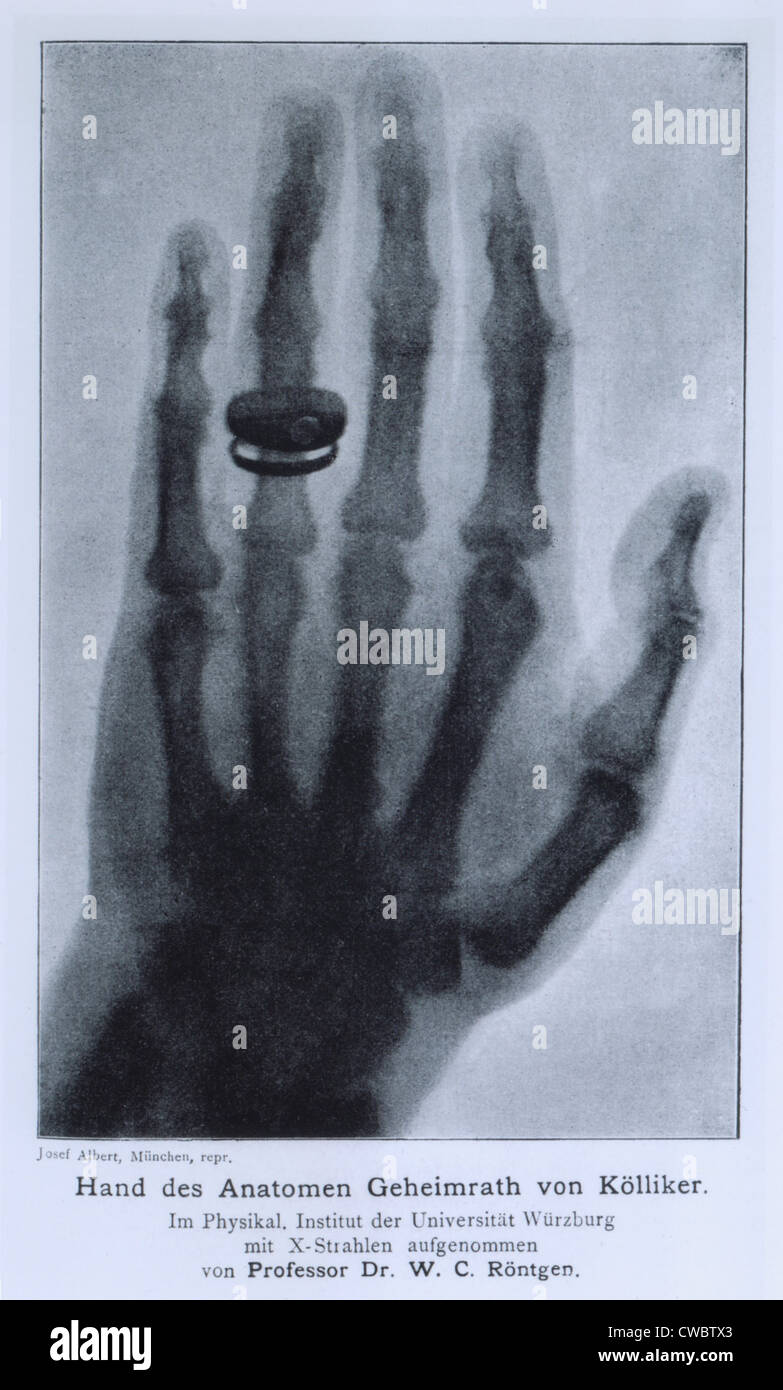 Konrad Roentgen Röntgen der Hand von Professor Albert von Kölliker, mit Knochen und den Ring er trug. Die x-ray war Stockfoto