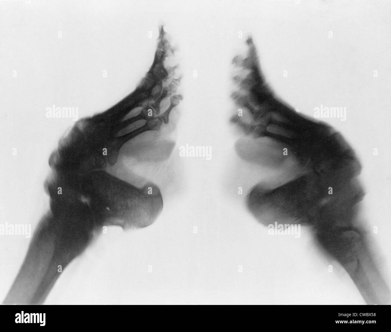 X-ray eine Frau gefesselten Füße, China.  Ca. 1890-1923. Stockfoto