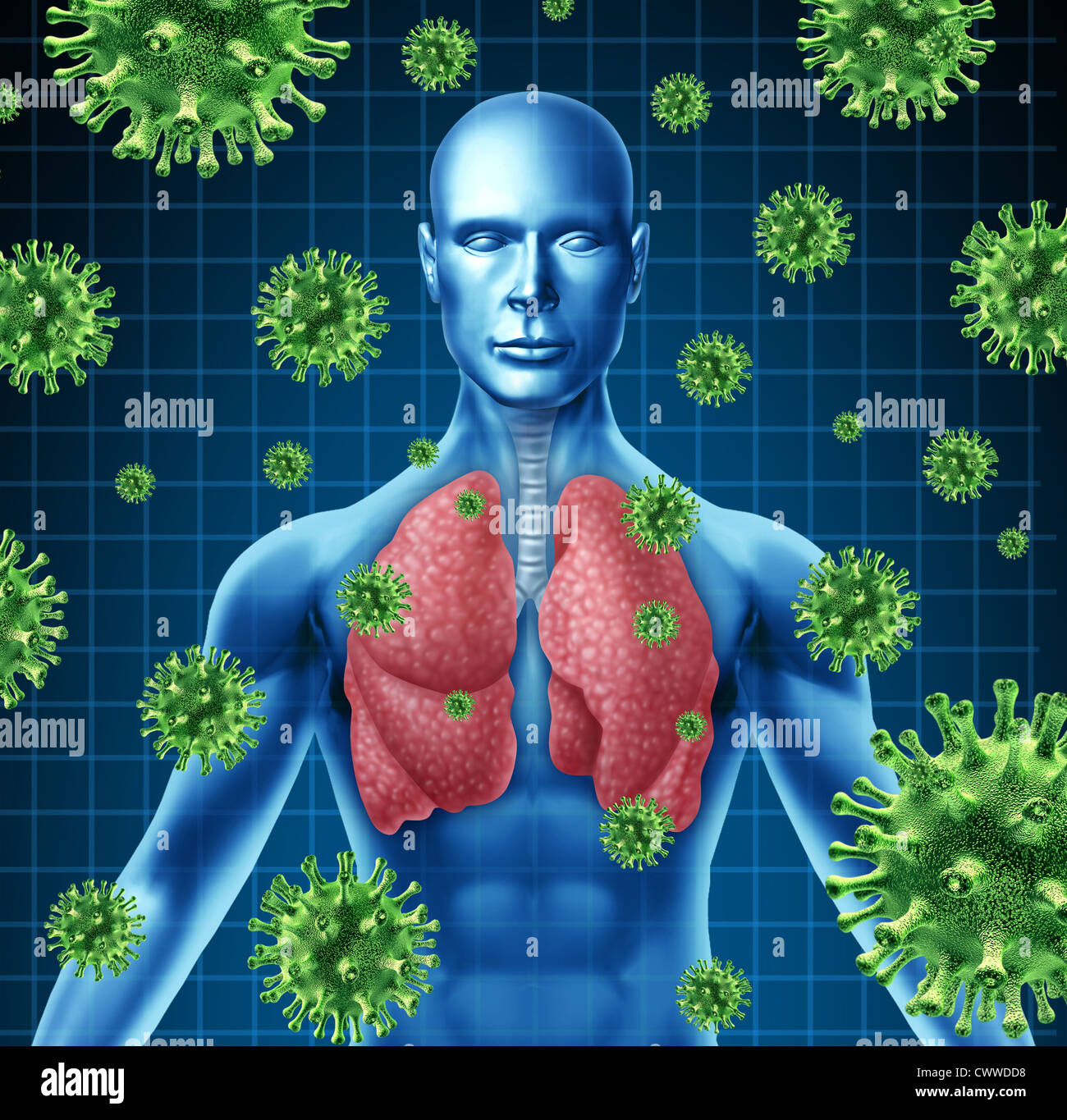 Lungenentzündung, vertreten durch ein Mensch mit Röntgenbild der Lunge und Körper mit Virus Zellen angreifen der Patient in einen Zustand Stockfoto