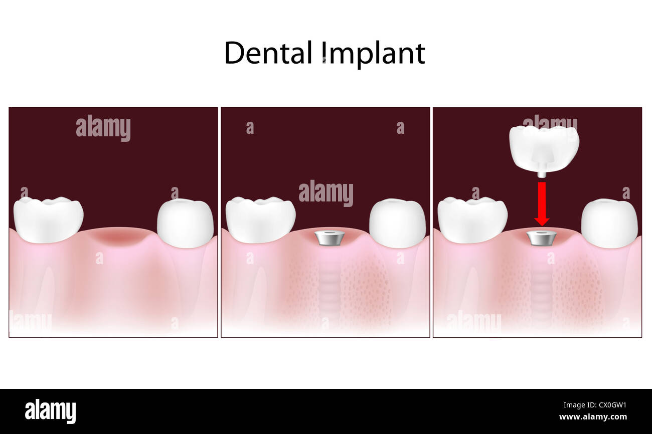 Zahnimplantat Verfahren Stockfoto