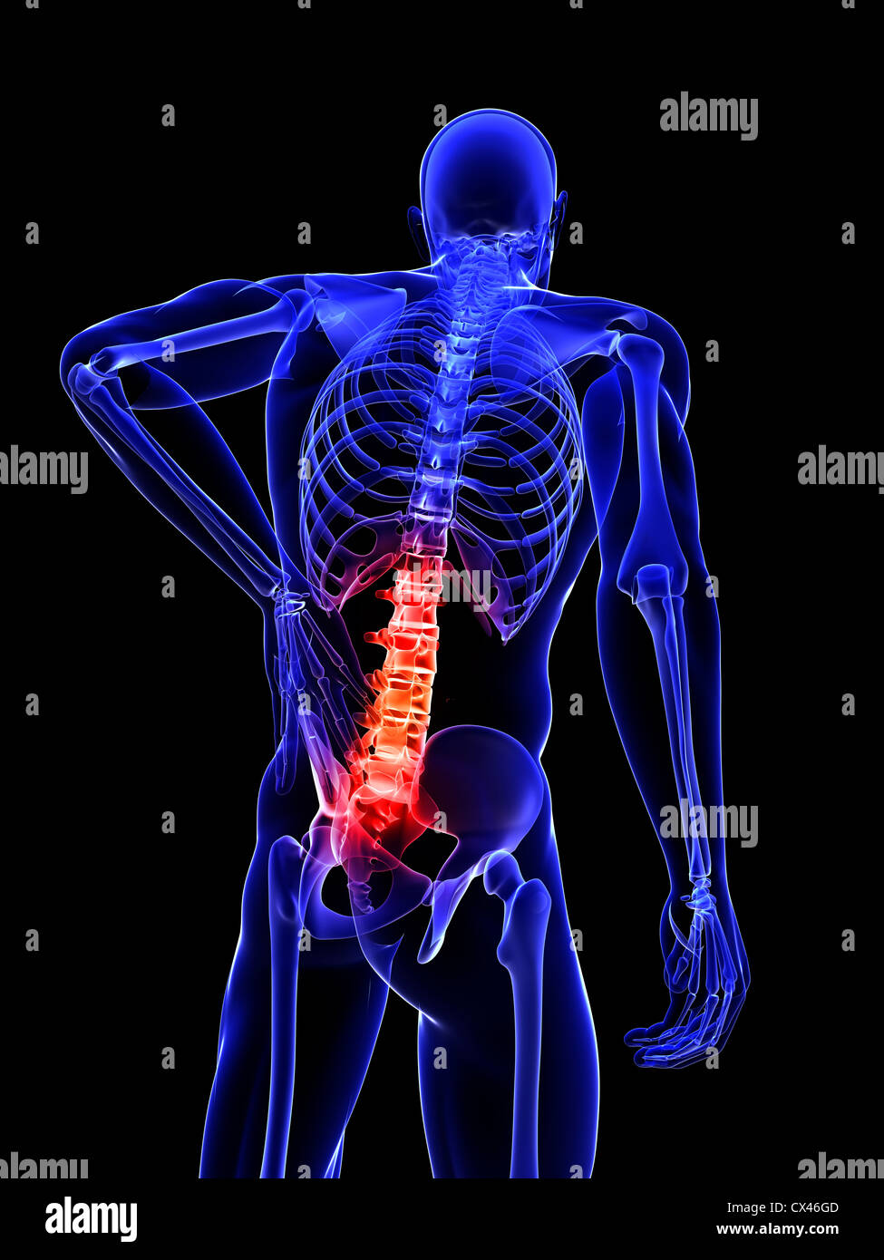 3D gerenderten medizinische Illustration - Rückenschmerzen - Röntgen-Stil Stockfoto