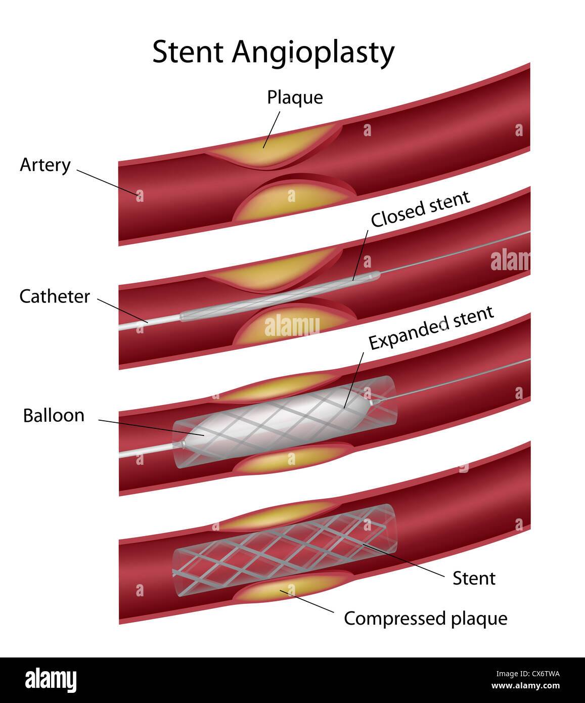 Stent-Angioplastie Stockfoto