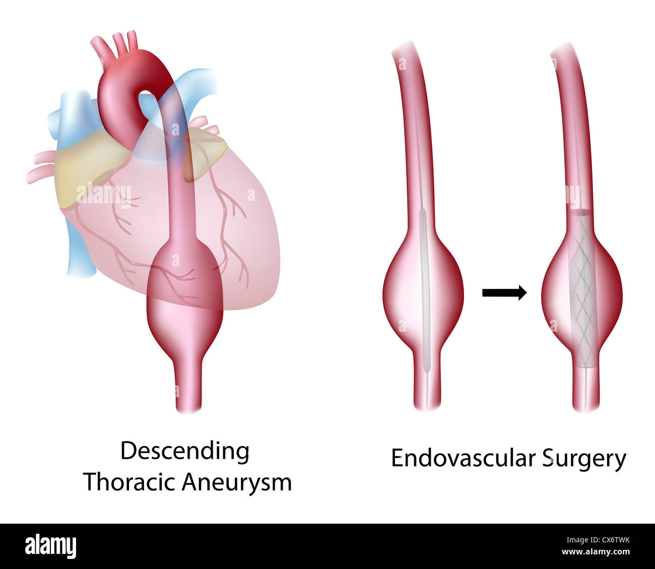 Thorax (absteigend) Aneurysma und endovaskuläre Aortenchirurgie Stockfoto