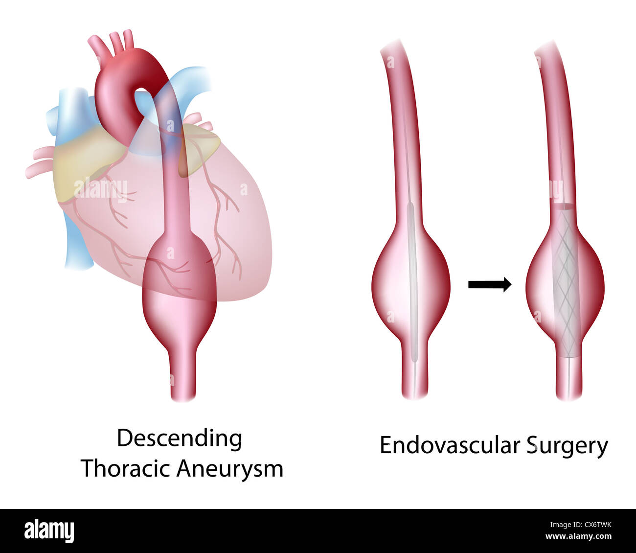 Aortenaneurysma Stockfotos Und Bilder Kaufen Alamy