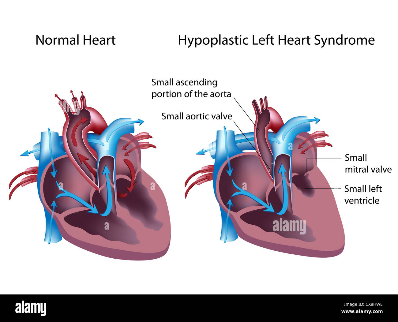 Hypoplastischen Linksherz-Syndrom (normal und Kranke) Stockfoto