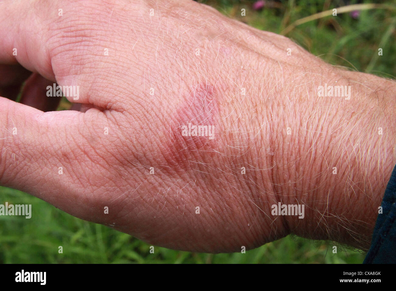 Kaukasischen Mann Hand zeigt eine verbrennen Mark Verletzung seiner Haut Modell freigegeben Stockfoto