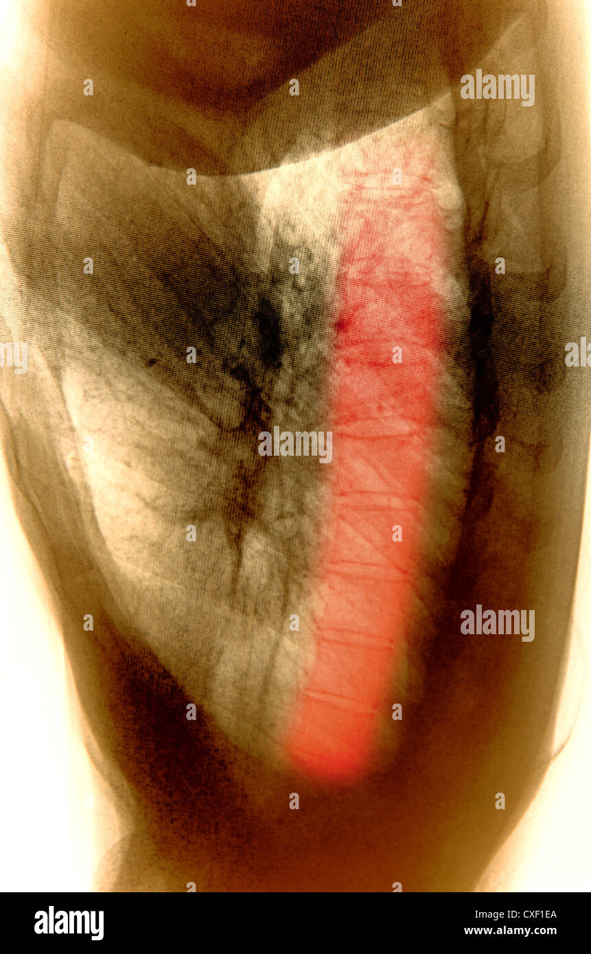 x-ray menschlicher Muskel Stockfoto