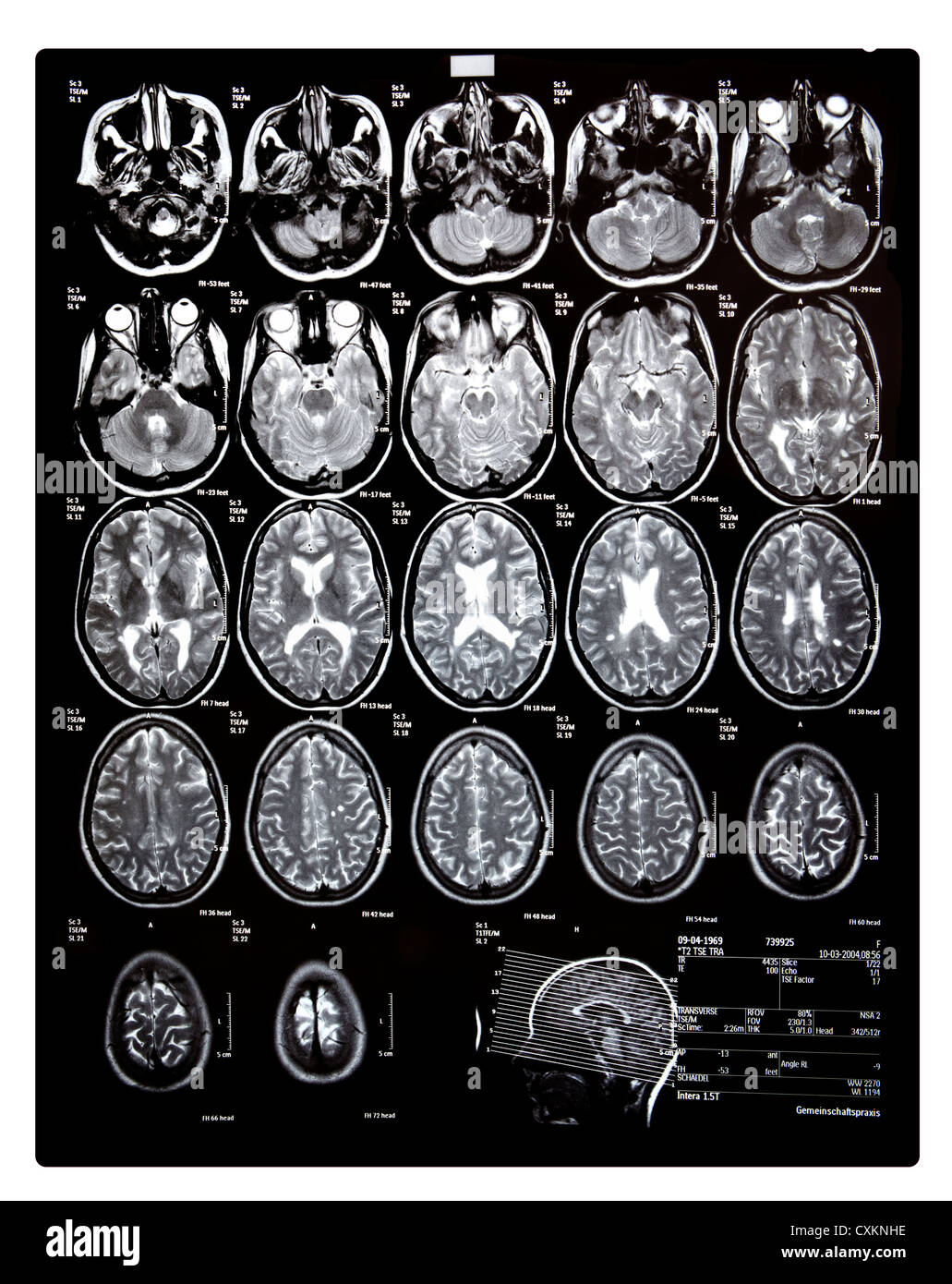 Computertomographie, CT-Scan des Kopfes einer jungen Frau, die Multiple Sklerose, MS hat, Stockfoto