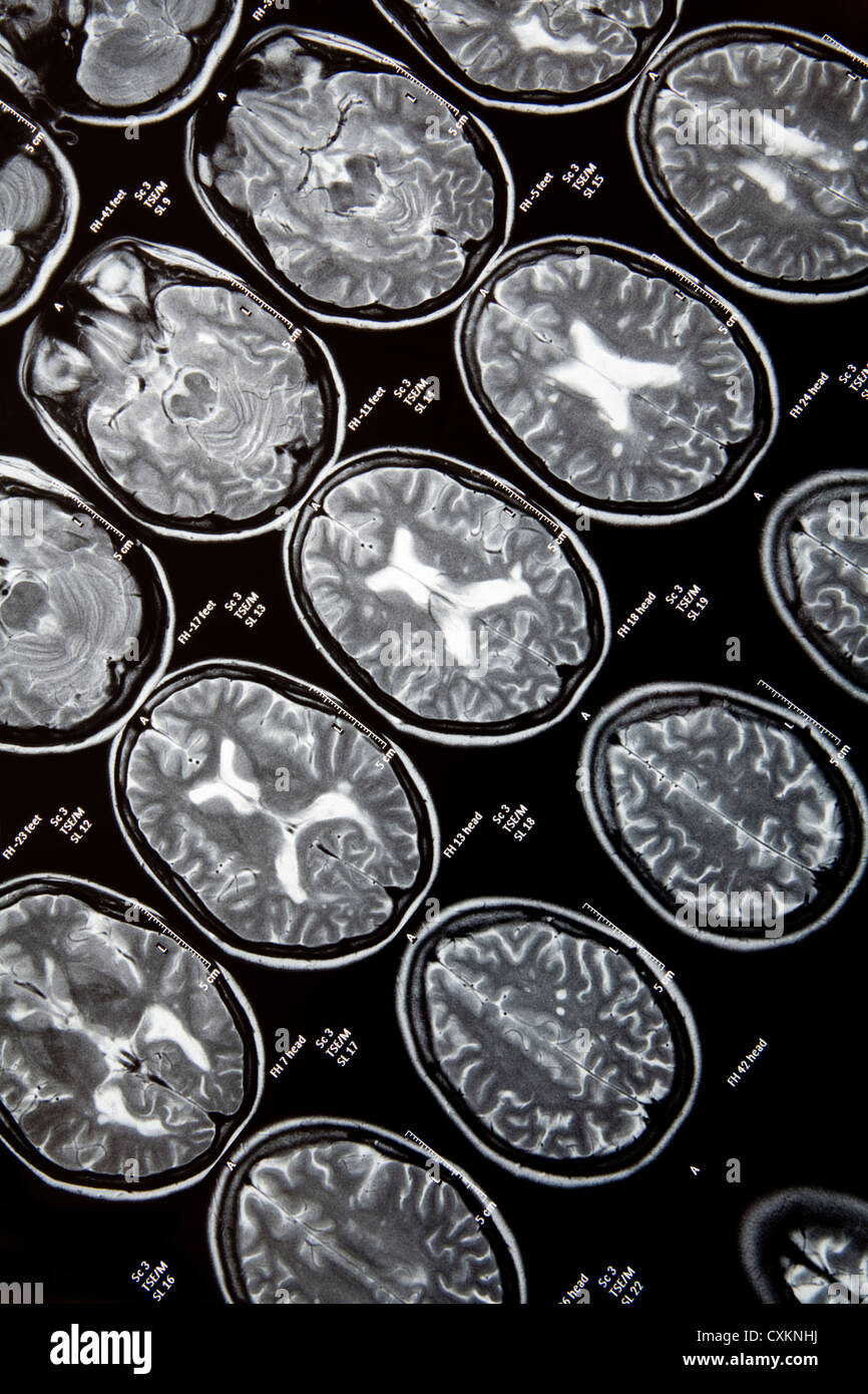 Computertomographie, CT-Scan des Kopfes einer jungen Frau, die Multiple Sklerose, MS hat, Stockfoto