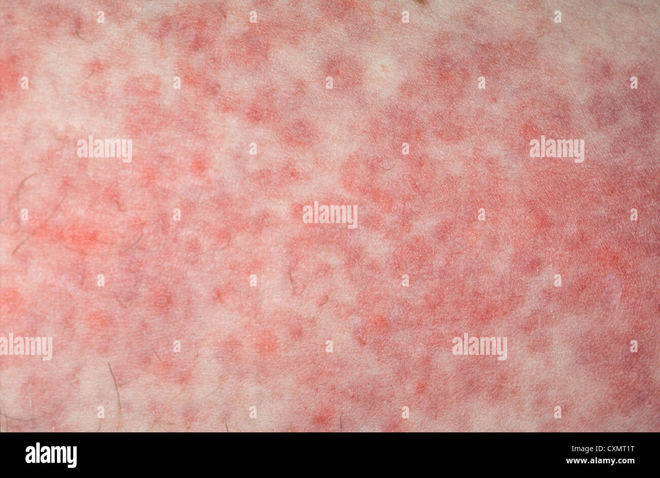 Makula hautausschlag Fotos und Bildmaterial in hoher Auflösung Alamy