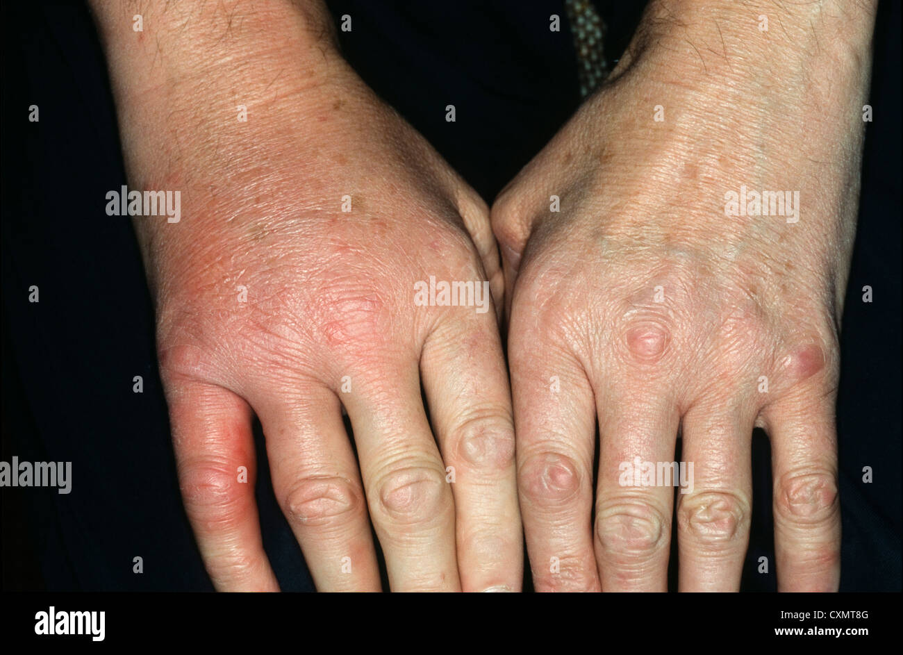 Schwellung hand Fotos und Bildmaterial in hoher Auflösung Alamy