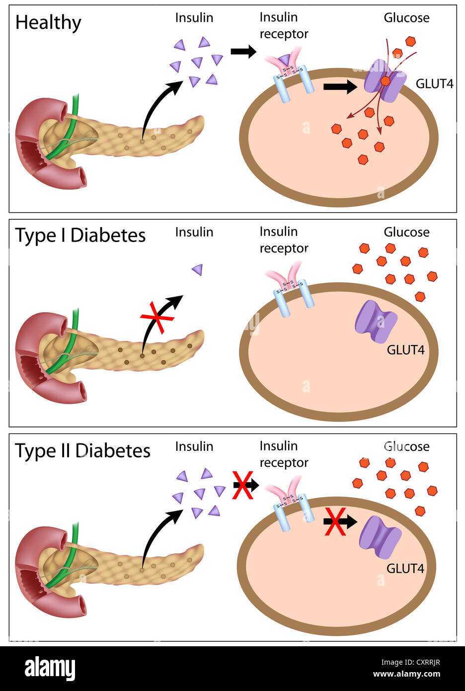 Insulinwirkung Und Diabetes Typ 1 Und 2 Stockfotografie Alamy