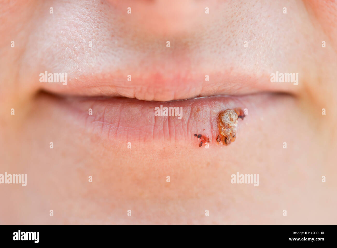 Frau mit Herpes Simplex Labialis auf den Lippen Stockfoto