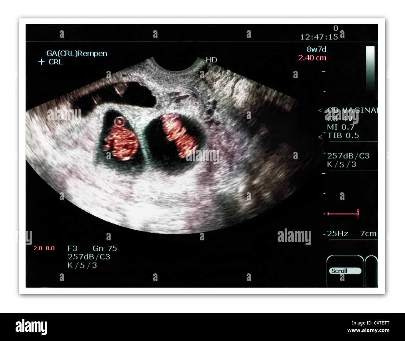 Ultraschall von einer schwangeren Frau tragen von Zwillinge Stockfoto