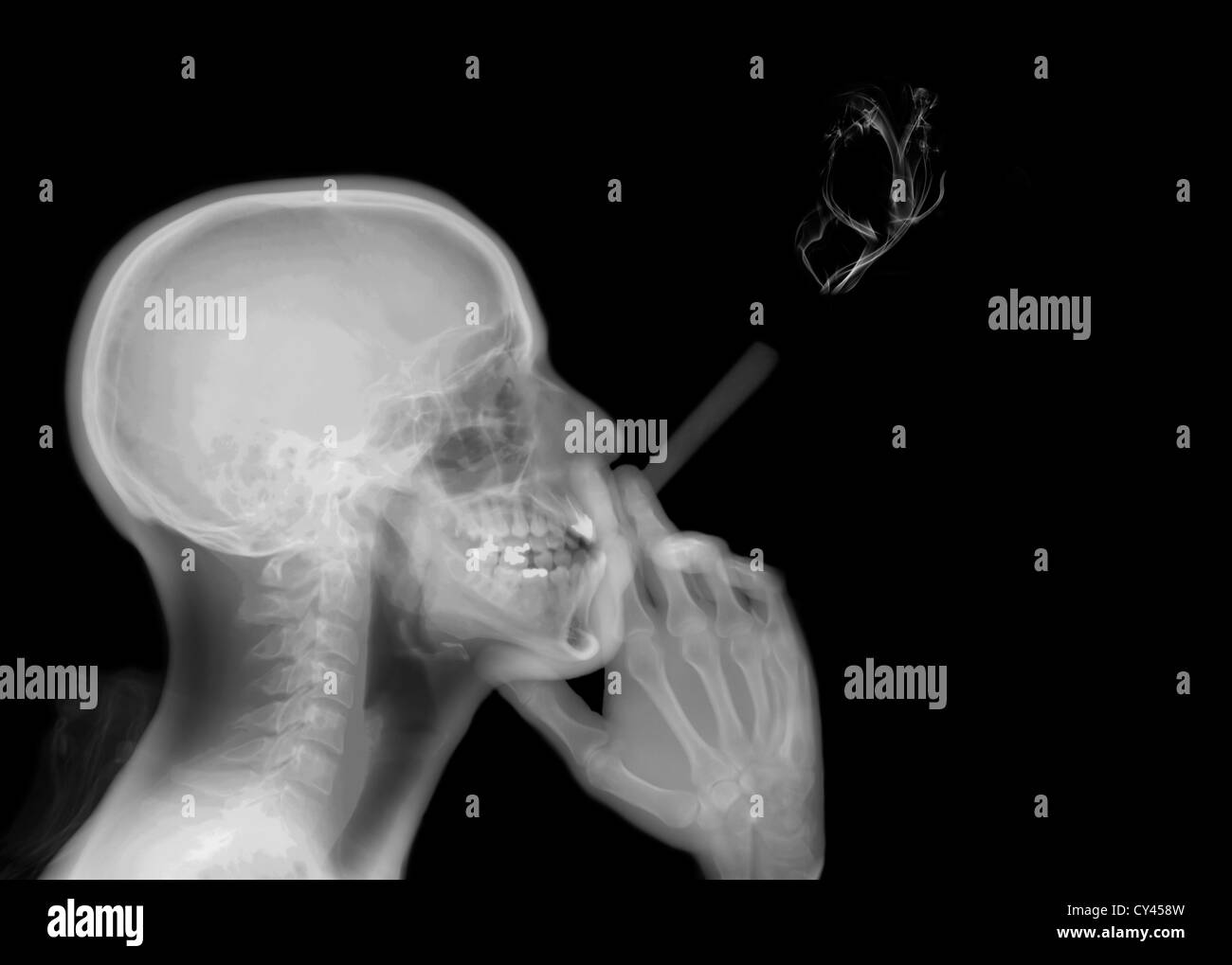 Röntgenbild eines Mannes, eine Zigarette rauchend Stockfoto