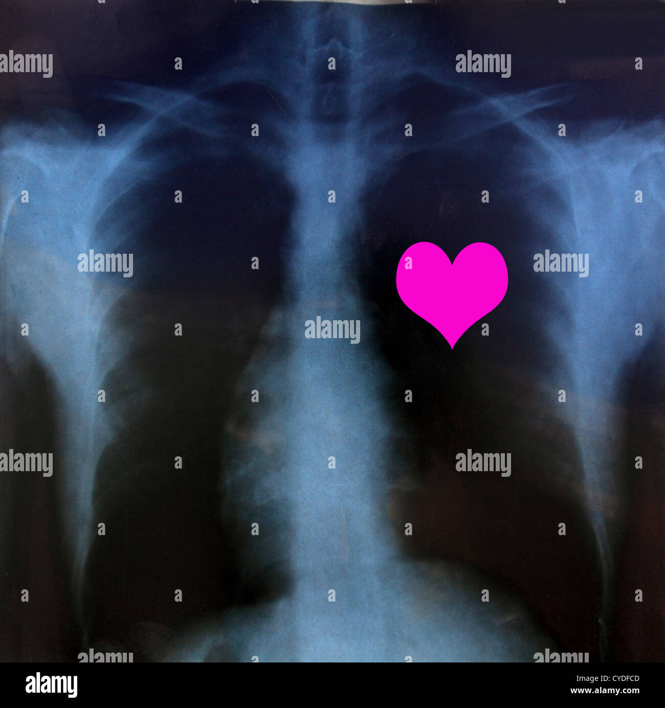 Röntgen-Herz Stockfoto
