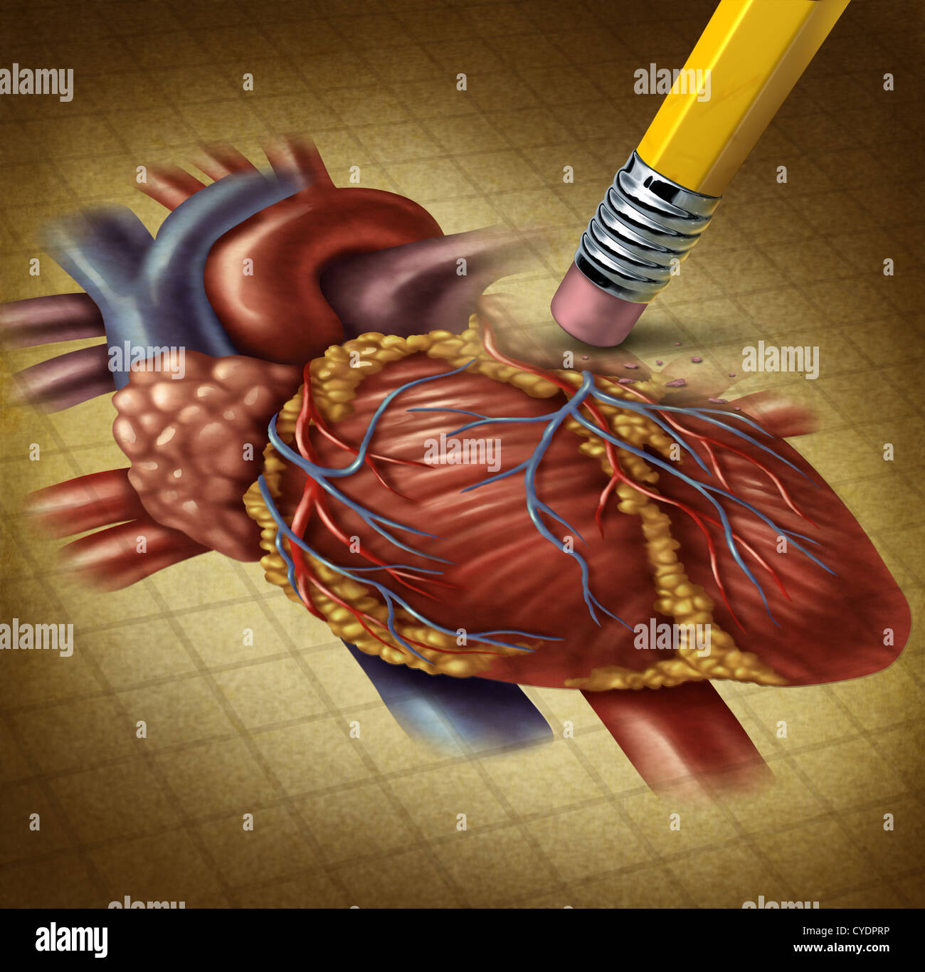 Gesundheit des menschlichen Herzens und eines Rückgangs der Durchblutungsstörungen verursacht für das Herz-Kreislauf-System als ein Radiergummi Löschen einer alten Grunge medizinische Illustration auf Pergamentpapier zu verlieren. Stockfoto