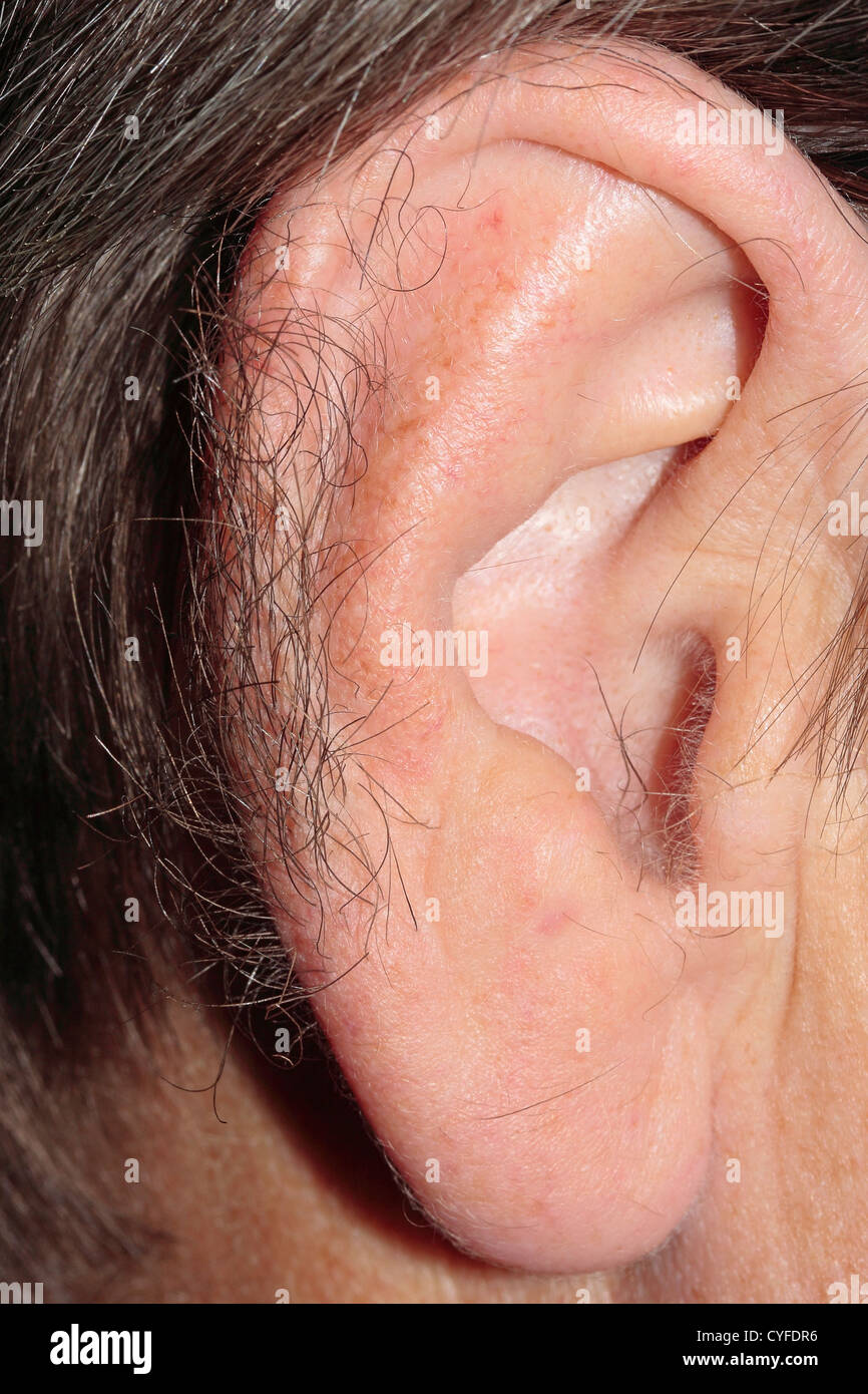 Hypertrichosis (übermäßige Behaarung) der Ohr-Felgen Stockfoto