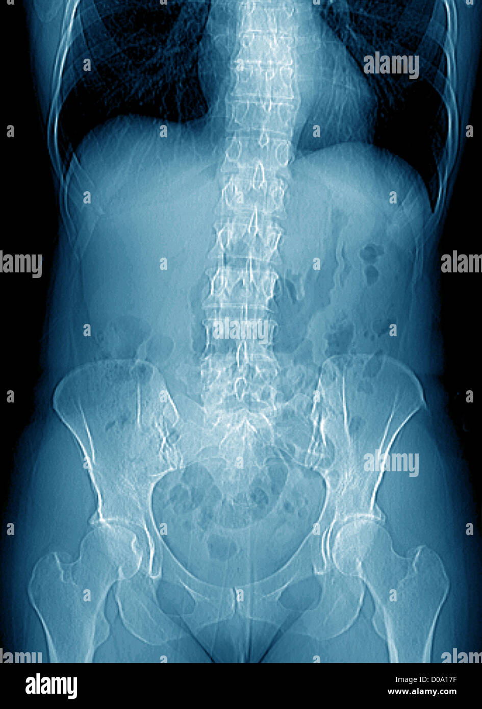 BECKEN, X-RAY Stockfoto