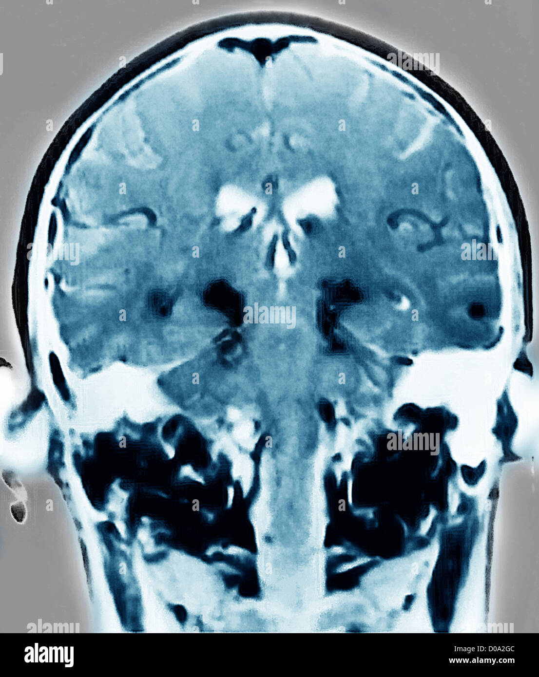 PARKINSON-KRANKHEIT, MRT Stockfoto