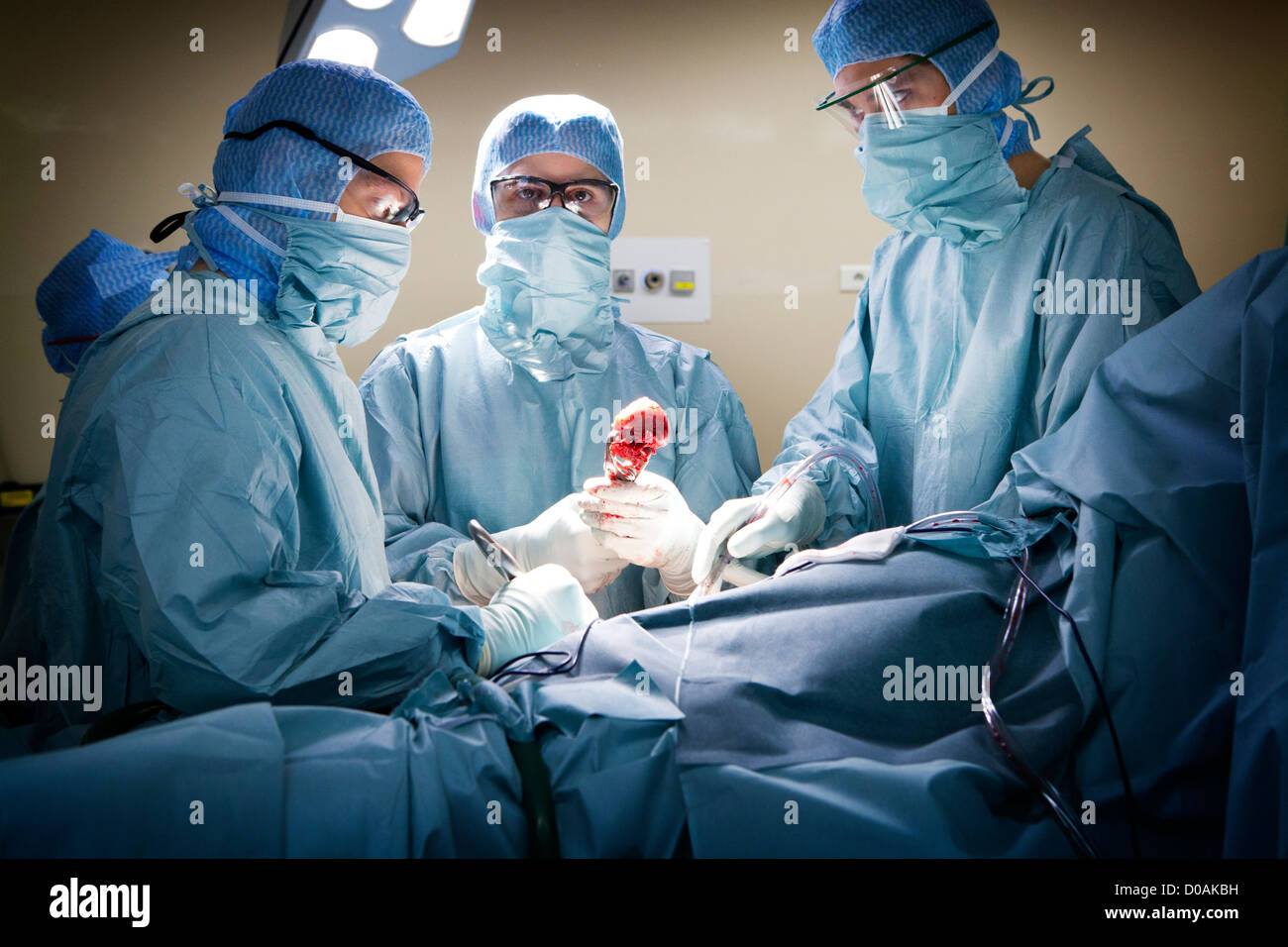 HÜFTPROTHESE, CHIRURGIE Stockfoto