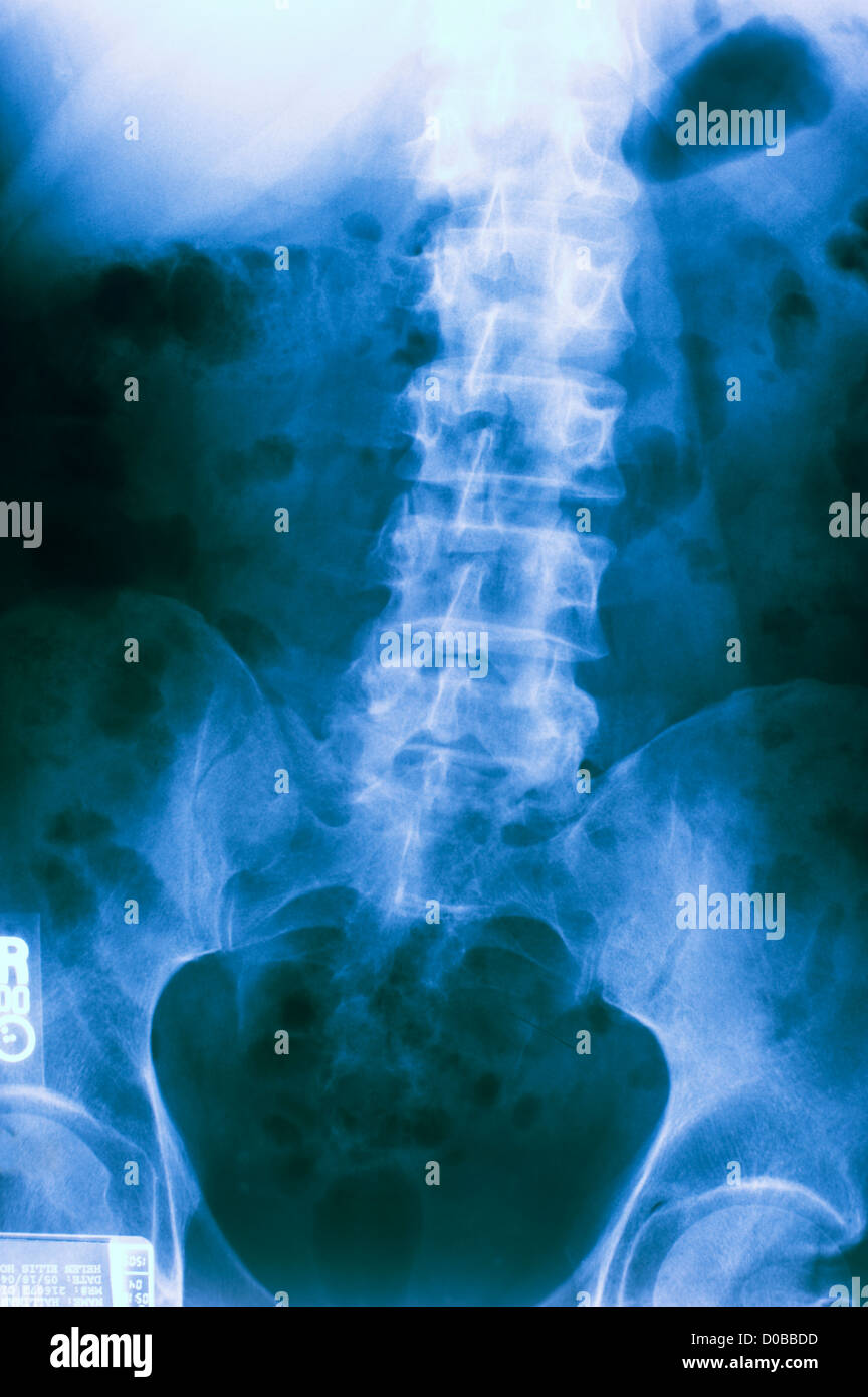 X-ray menschlichen männlichen Wirbelsäule Stockfoto