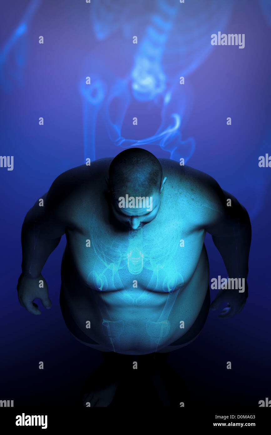 Menschliches Skelett über Körper des Mannes, die Schwere seiner Übergewicht Erkrankung offenbaren geschichtet. Stockfoto