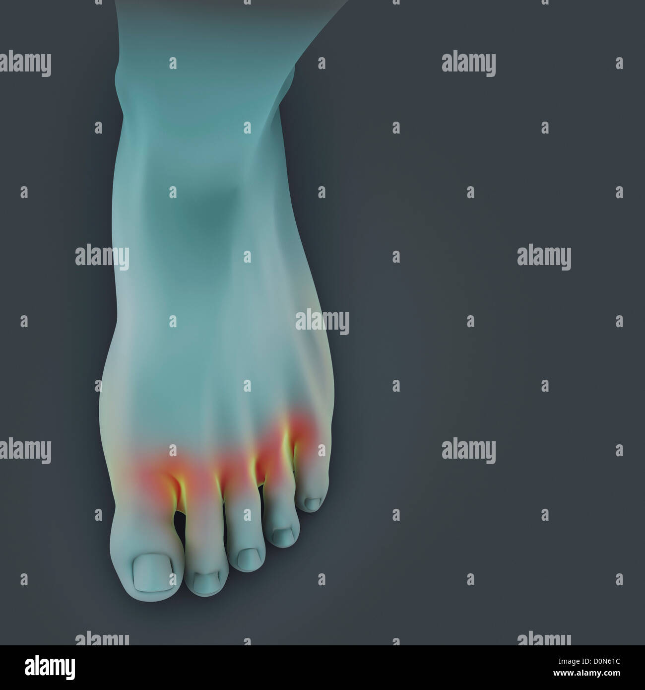 Ein linker Fuß strahlendes Aussehen. Fuß ist hervorgehobenen Stellen Präsenz Pilzinfektion Fußpilz genannt. Stockfoto