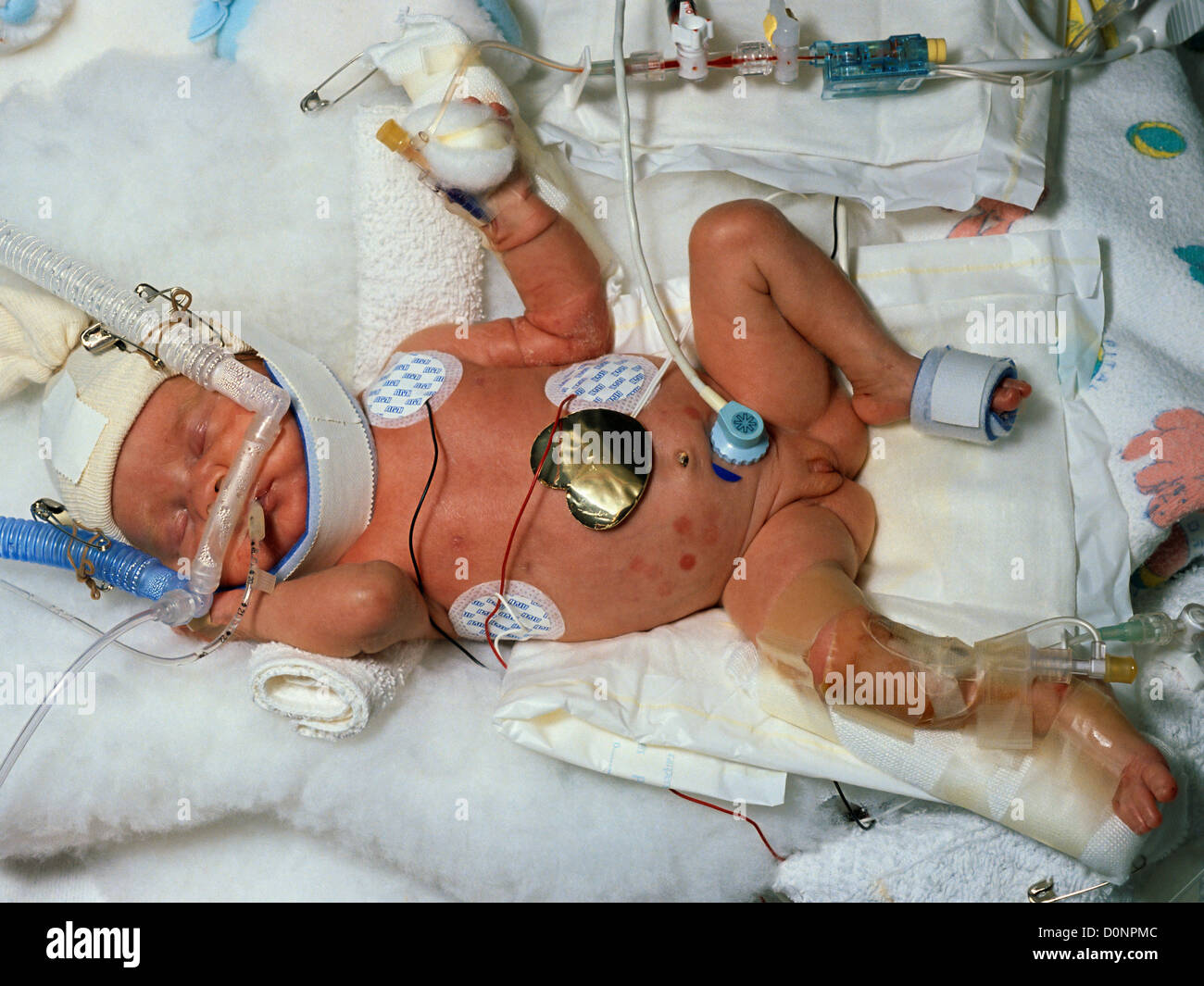 Frühgeborenen auf neonatale Intensivstation Stockfoto