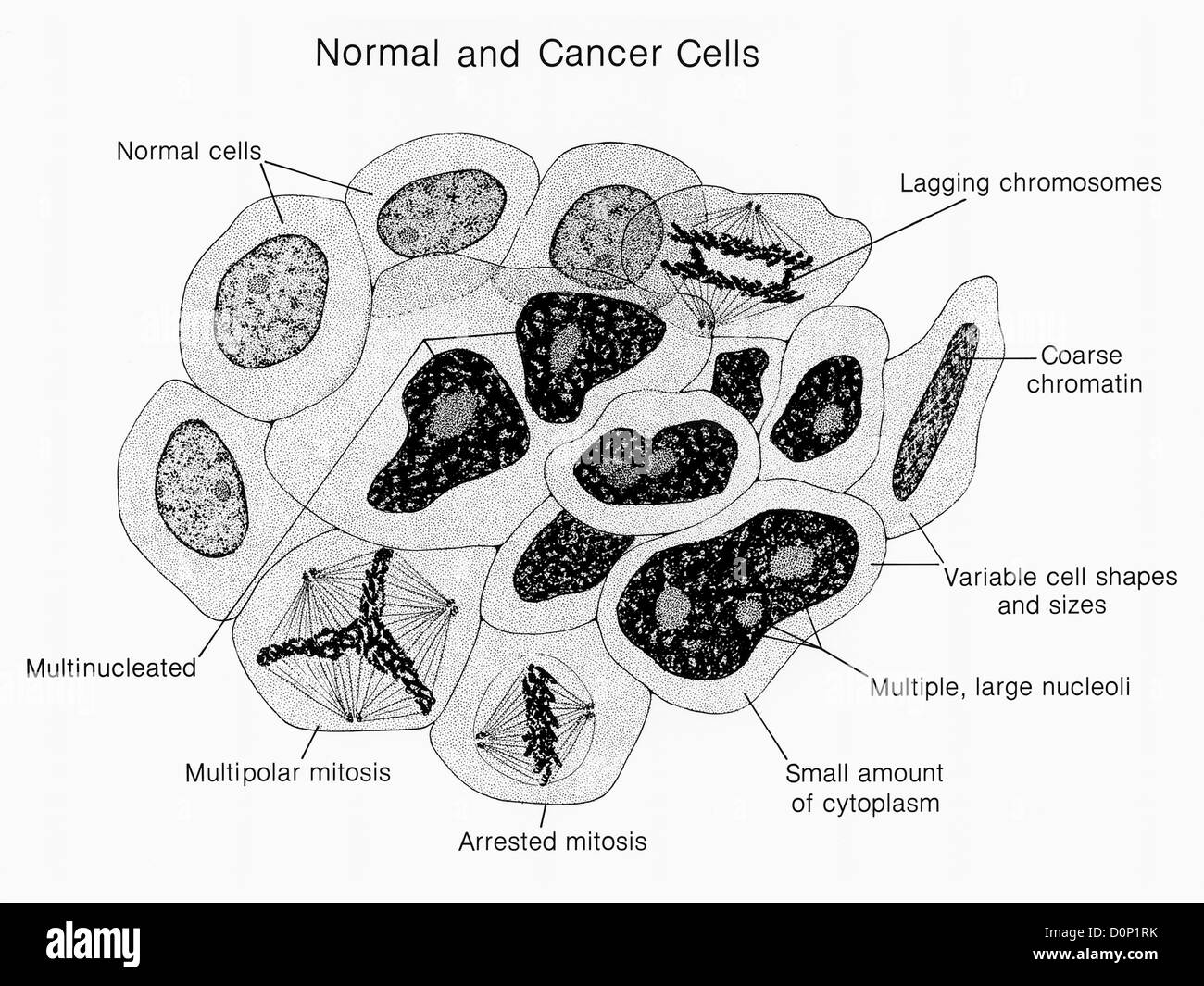 Des Künstlers Krebszellen Wiedergabe normalen Side-by-Side. normale krebsige Eigenschaften sind gekennzeichnet. Abbildung Pat Kenny. Stockfoto