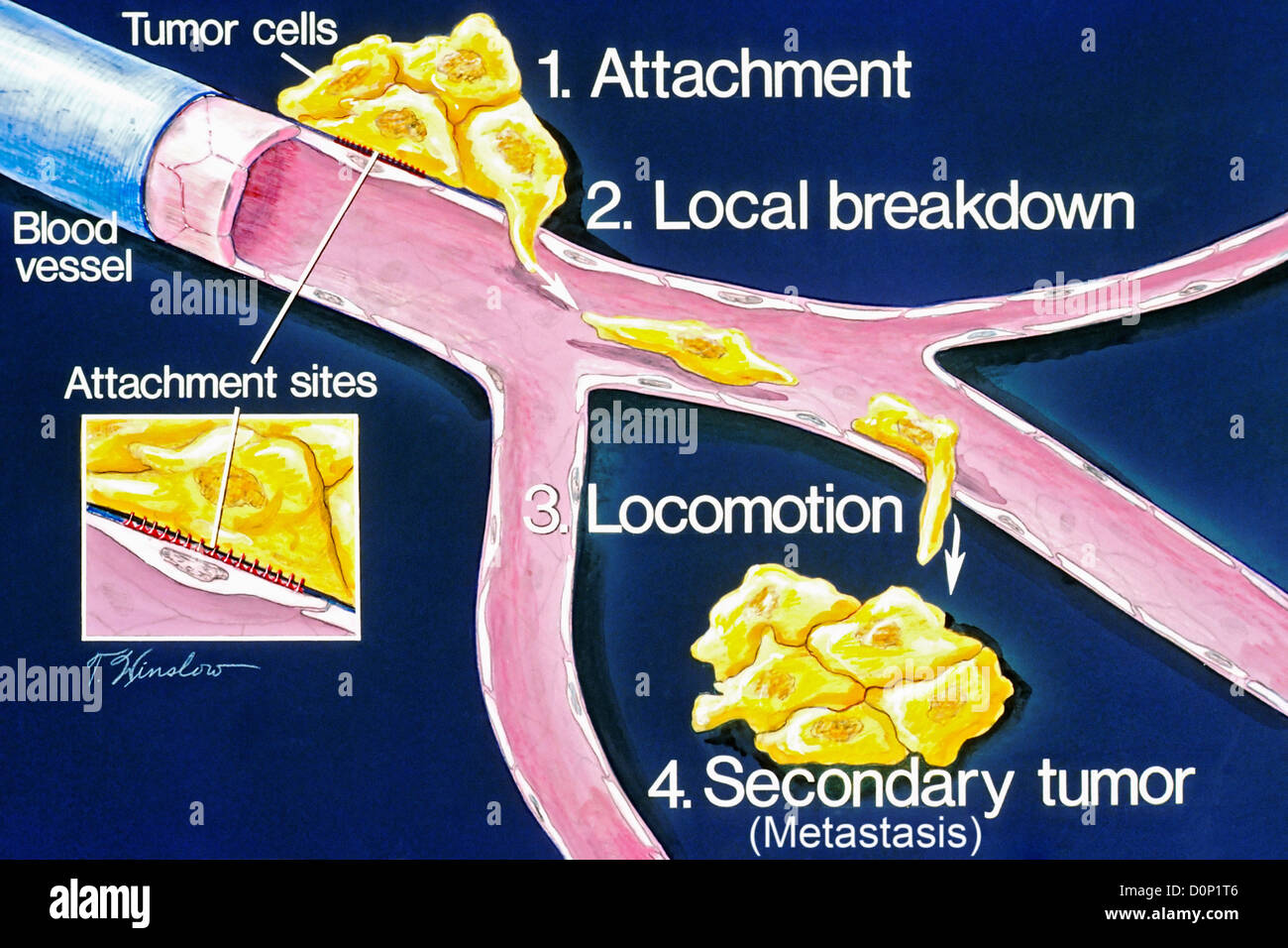 Dies ist die schematische Zeichnung Phasen Metastasen (1) Anhang 2) lokale Aufschlüsselung Fortbewegung (3) (4) sekundäre Tumor. Dies Stockfoto
