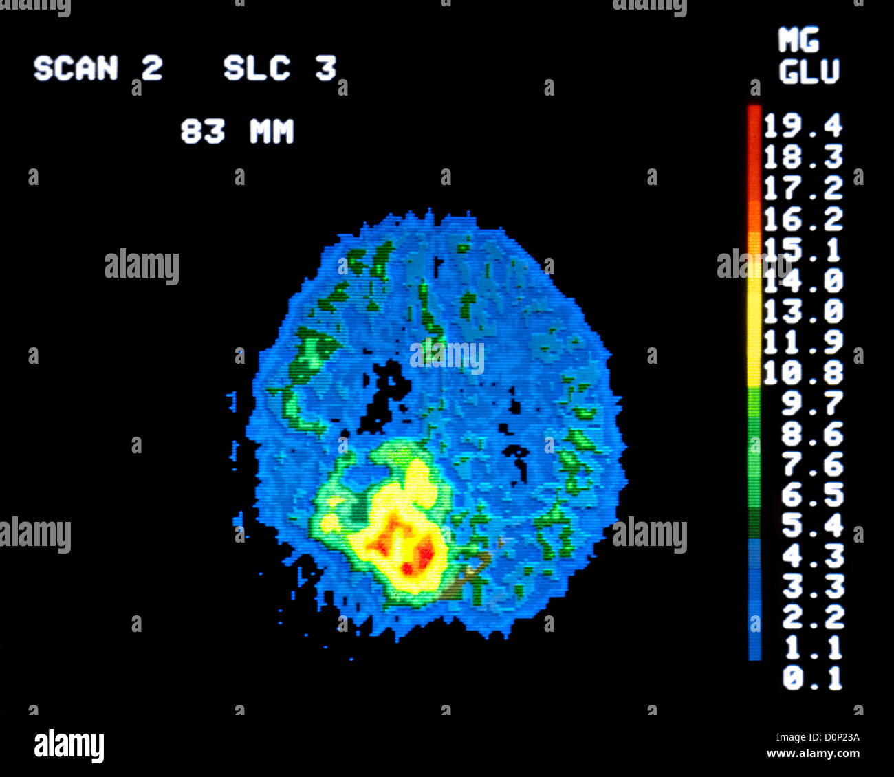 Ein PET-Scan (Positronen-Emissions-Tomographie) 62 Jahre alt Mann Hirntumor als Klasse III Astrozytom eingestuft. PET-Scan zeigt Stockfoto