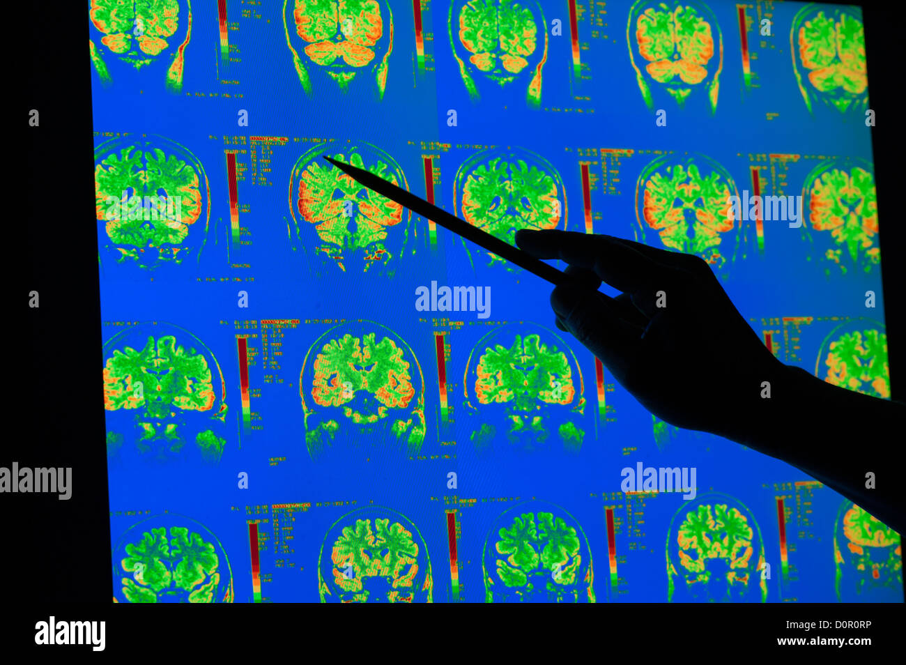 farbige Röntgenbilder der Großhirnrinde Kleinhirn menschliche Gehirn MRI Stockfoto