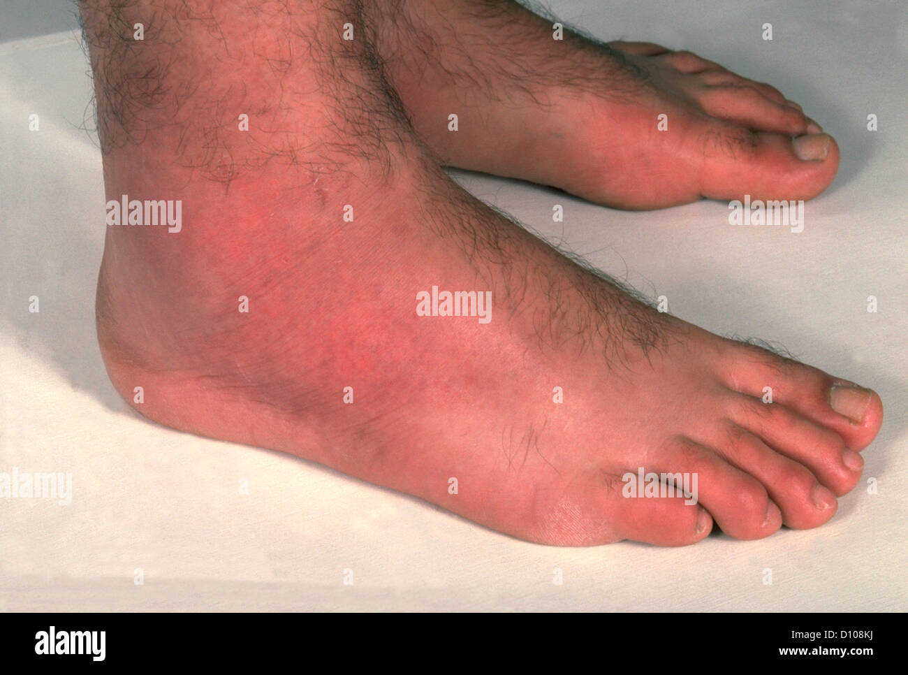 images Pictures Of Cellulitis On Ankle https www alamy de stockfoto cellulitis der beine 52252582 html
