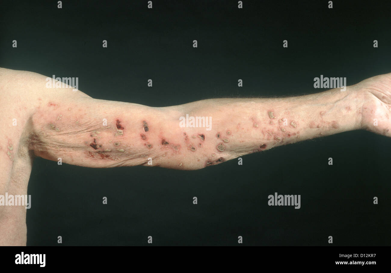 Shingles Herpes Rash Arm Stockfotos Shingles Herpes Rash Arm
