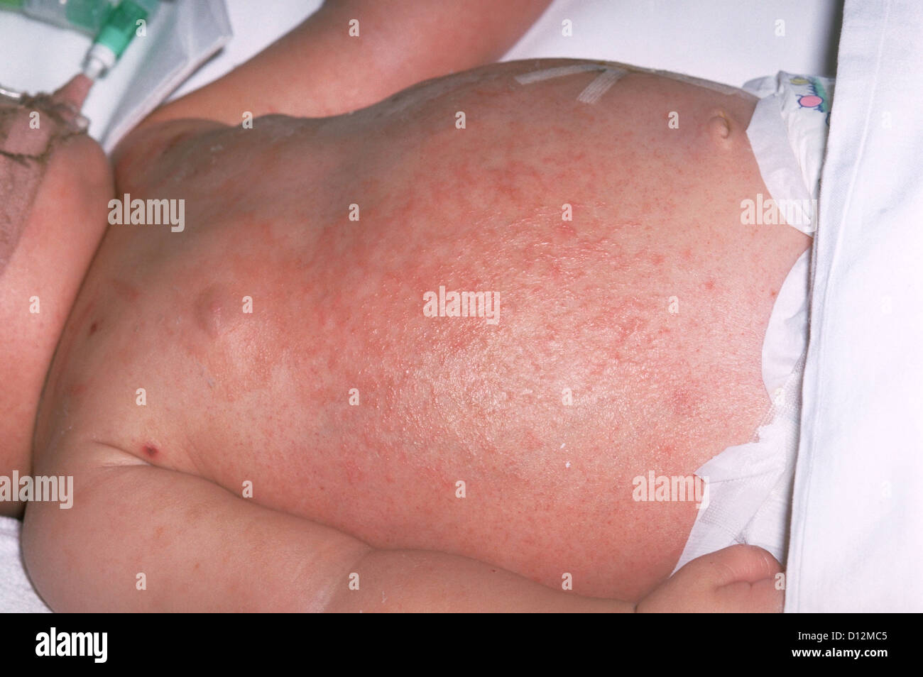 MENINGOKOKKEN BLUTVERGIFTUNG - HAUTAUSSCHLAG Stockfoto