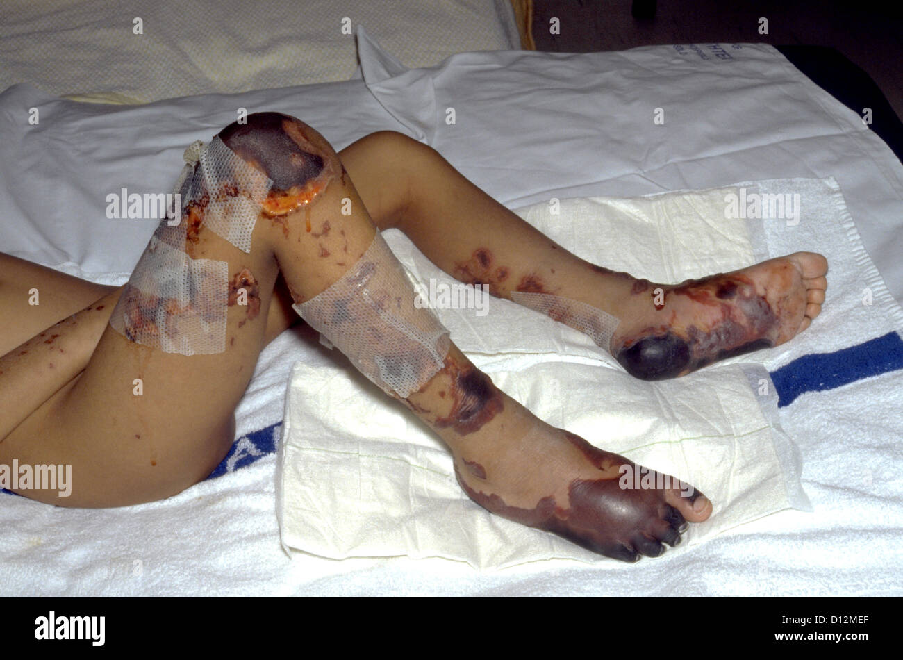 MENINGOKOKKEN BLUTVERGIFTUNG Stockfoto