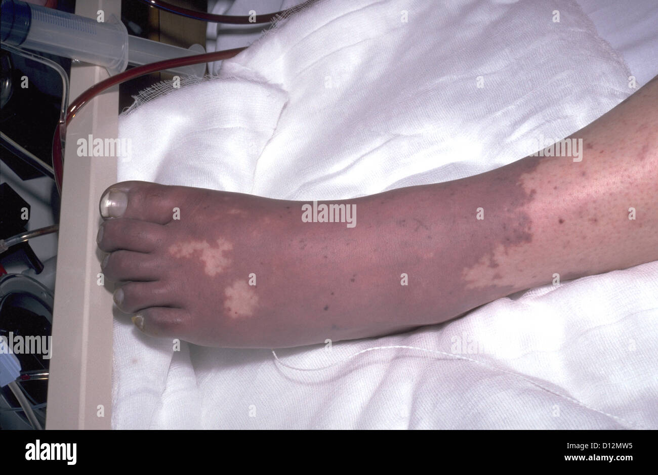 MENINGOKOKKEN-ERKRANKUNGEN Stockfoto