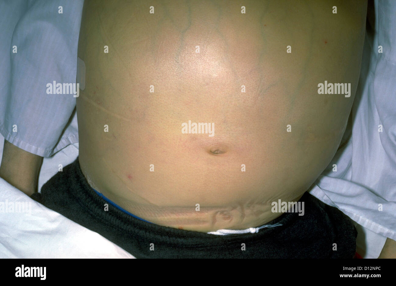 Leberversagen Und Gelbsucht Hepatitis B Positiv Stockfotografie Alamy