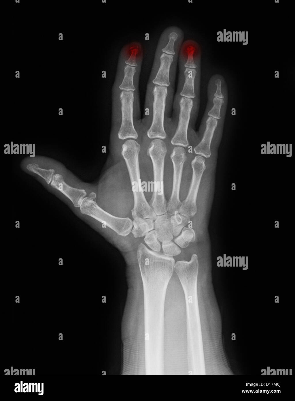 Röntgenaufnahme der Hand mit zerkleinerten Zeigefinger Stockfoto
